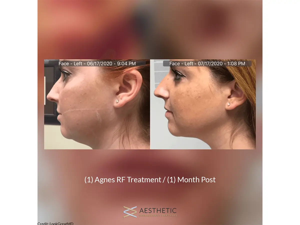 What to expect from AGNES Precision RF treatment at Secrets Aesthetics & Wellness in Orlando, FL.