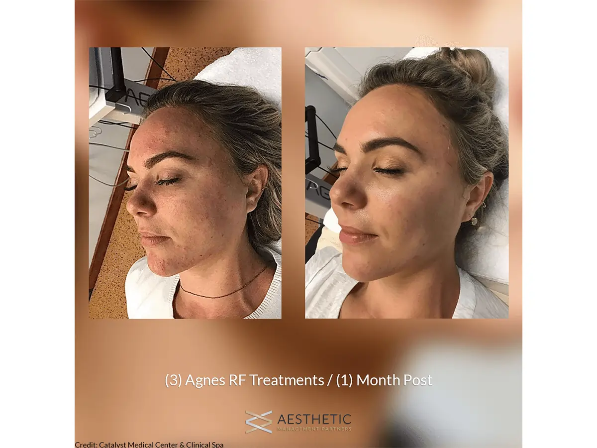 AGNES Precision RF treatment at Secrets Aesthetics & Wellness in Orlando, FL.