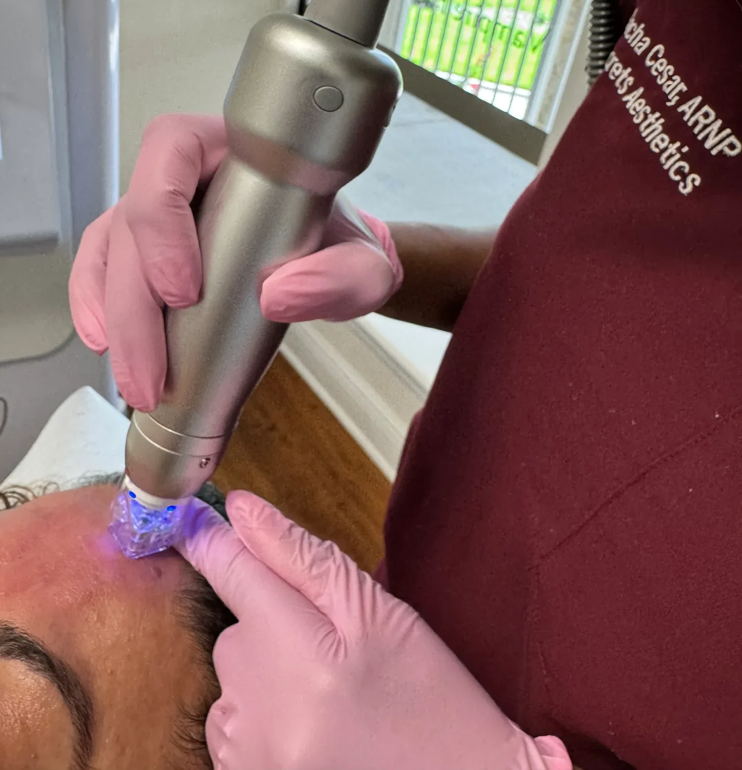 Your Premier Destination for RF Microneedling Treatments In Orlando e1736792446780