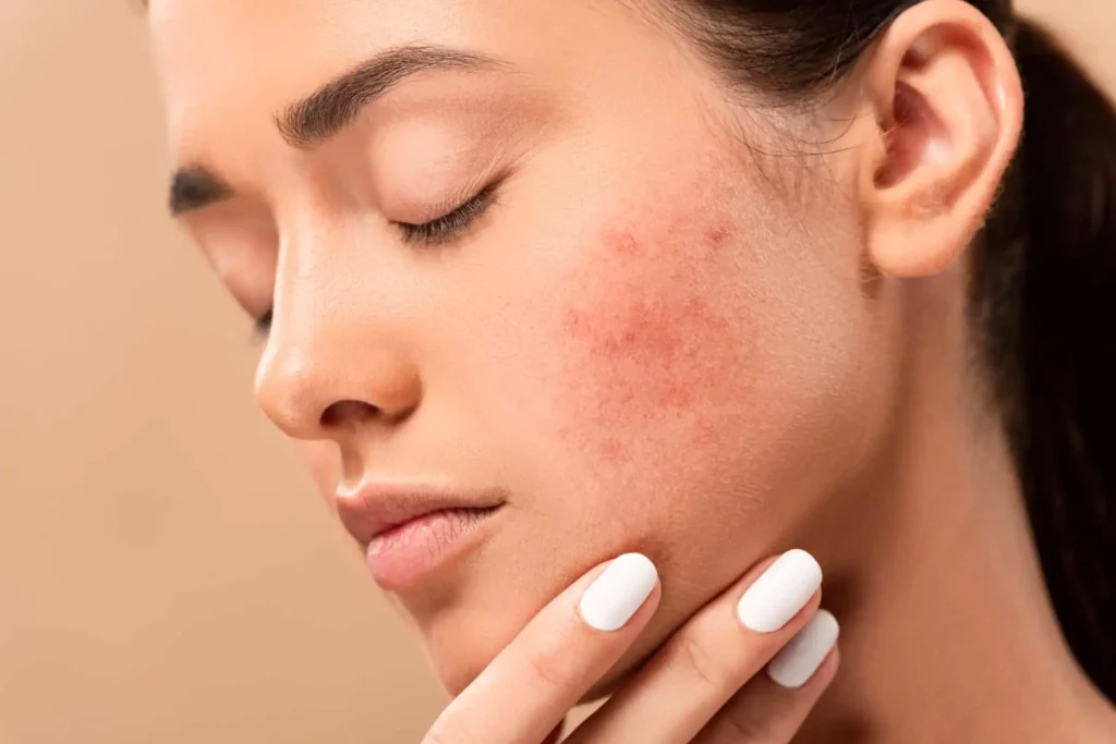 Rosacea in Orlando FL by Secret Aesthetics and Wellness Center LLC